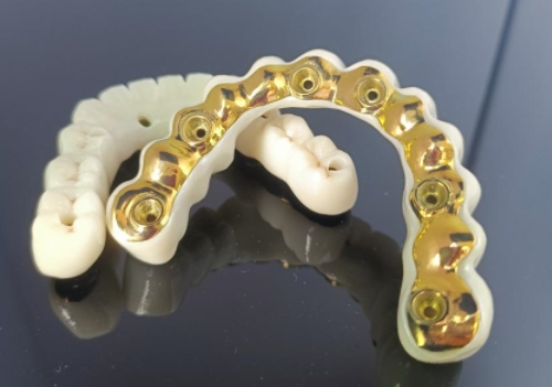 CAD/CAM Titanyum İmplant Çubuğu+Zirkonya Köprüsü