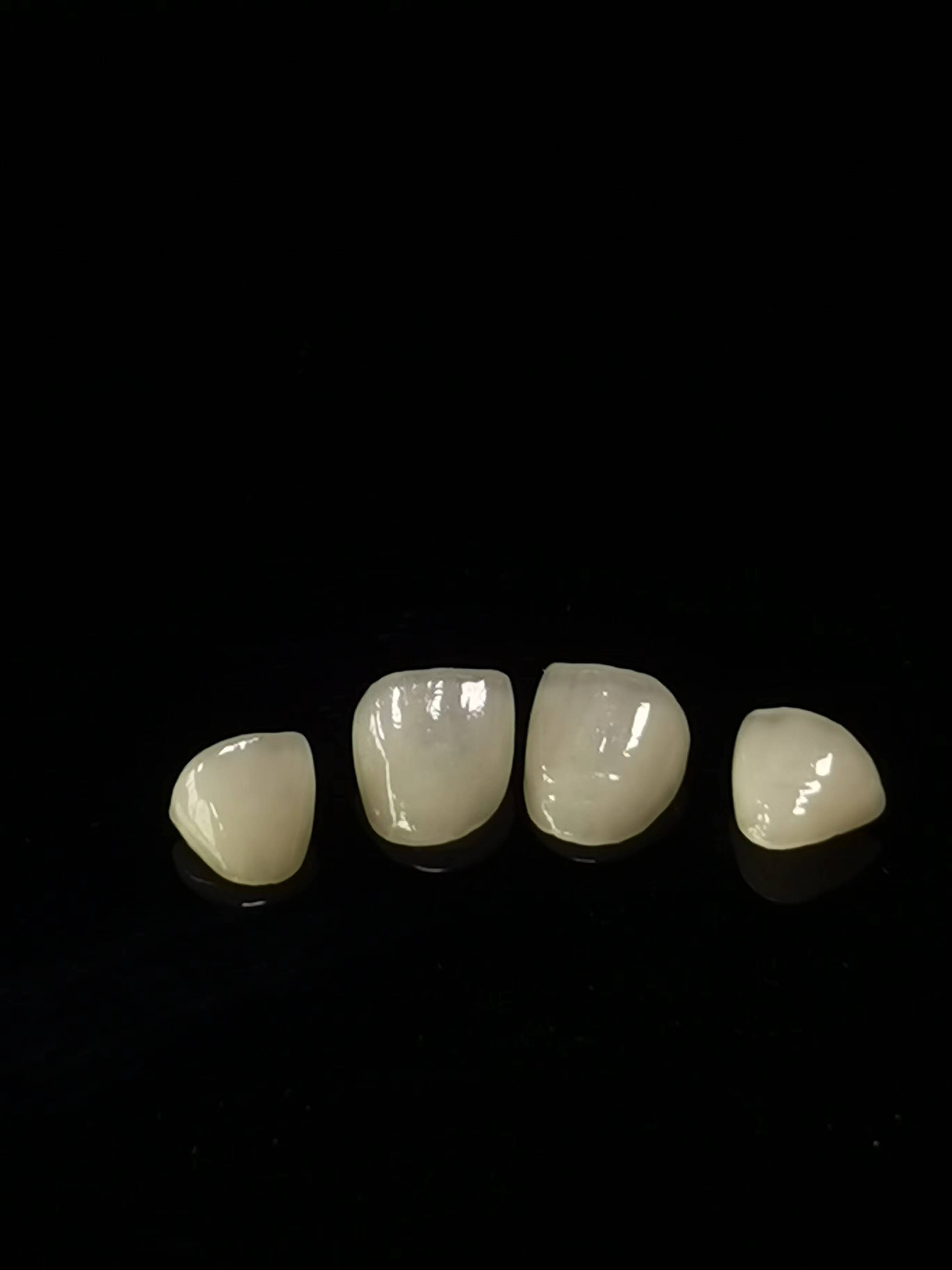 E.max Diş Laboratuvarı Çalışması