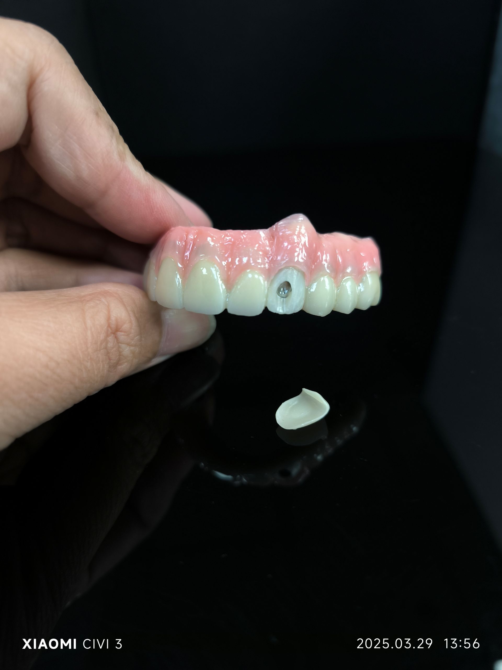 Tüm 4 - Vestibüler vidalı delik için hibrid zirkonya köprü çözümü
