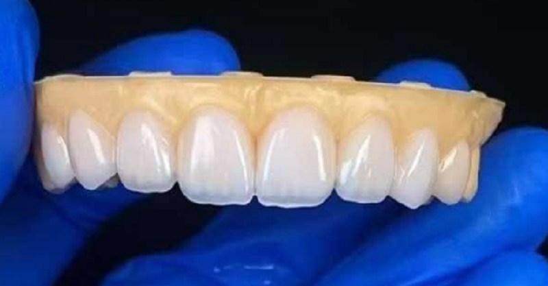 Aşırı diş boşlukları sorununu onarmak için diş kaplamaları