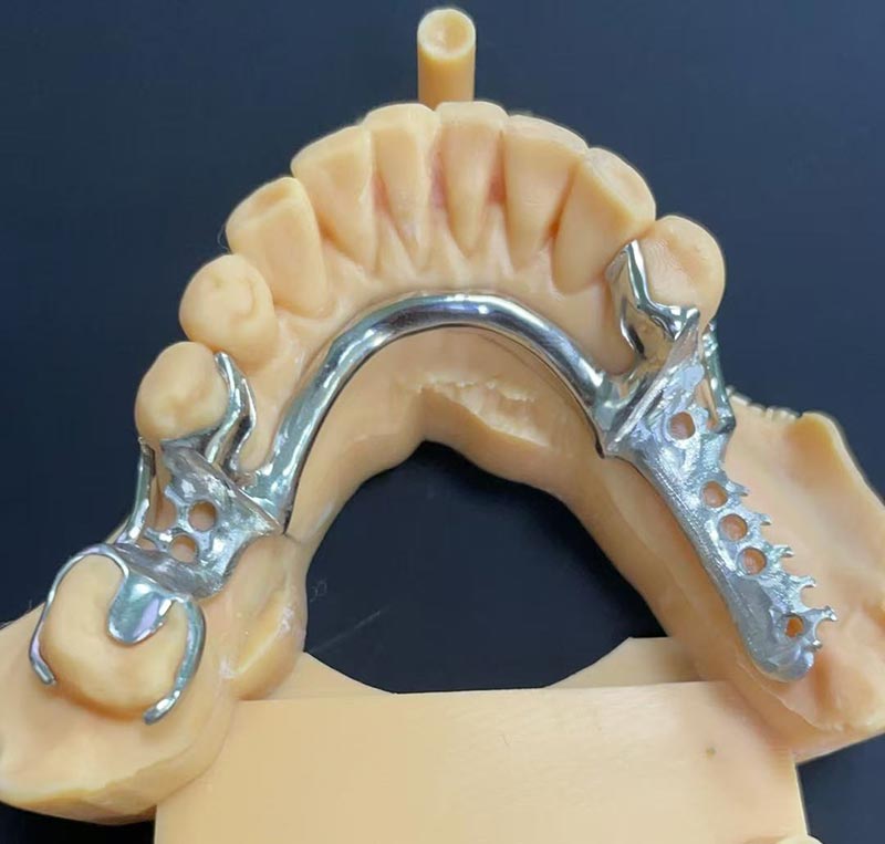 Kobalt-Krom Çerçevesinin (Co Cr Çerçeve) Avantajları