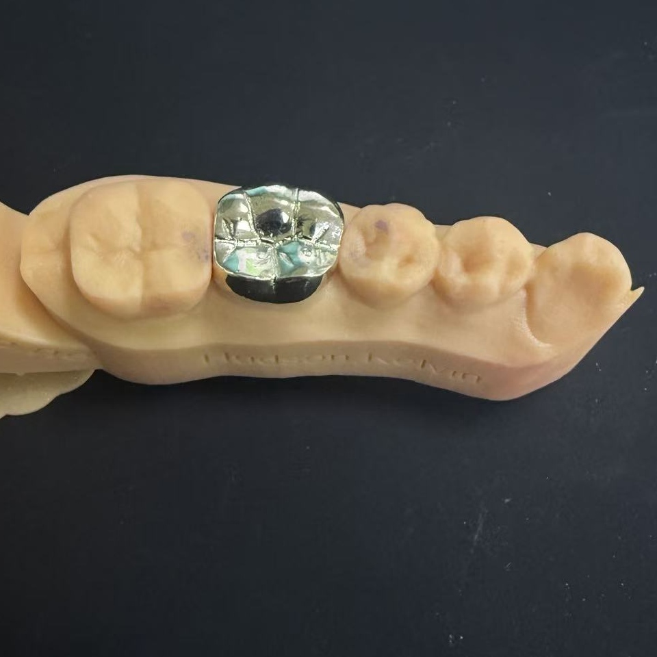 Altın Taçlar: Yaşam Boyu Diş Restorasyonu için Değerli Metal Seçimi