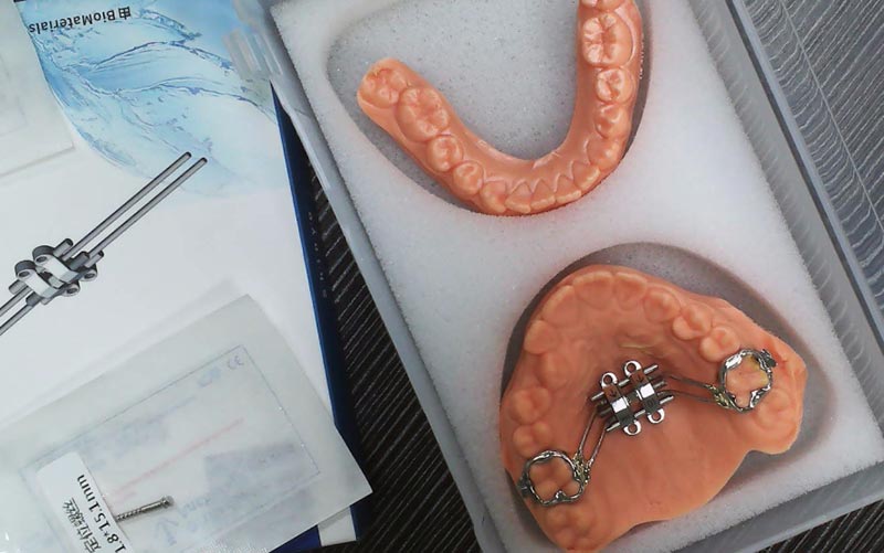 WM Dental Laboratuvarı ile MSE İskelet Genişlemesini Anlayın