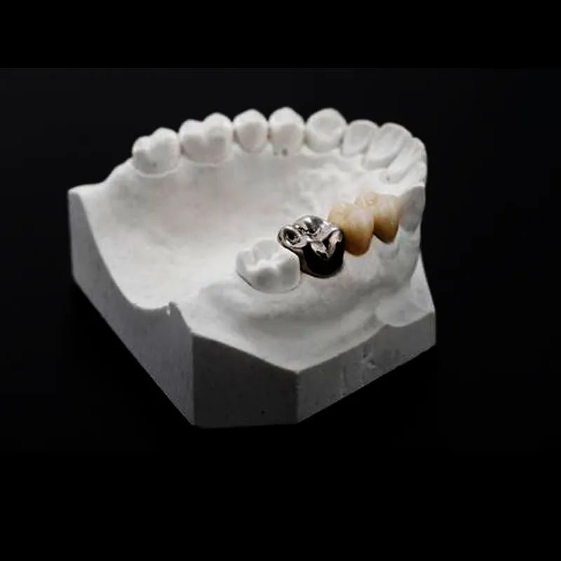 Klinisyenler Posterior Restorasyonlar İçin Ne Zaman Tam Metal Kaplama Seçmeli?