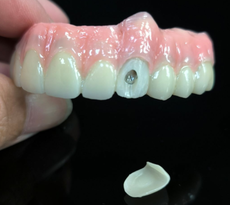 Vestibüler vida deliği için tüm 4 hibrid - hibrid zirkonya köprü çözümü