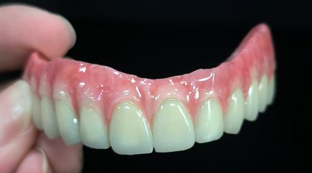 Tüm 4 Hibrid - Malo Köprüsü Titanyum Yapısı Üzerinde Tam Zirkonya Kronları