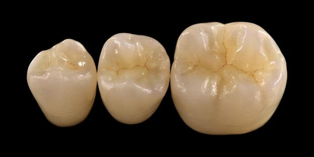<h2>Diş Hekimliğinde Zirkonya: Endikasyonları, Avantajları ve Klinik Hususlar</h2>
<p>Zirkonya, gücü ve dayanıklılığı ile yaygın olarak tanınmaktadır. En yeni nesil zirkonya malzemeleri de önemli ölçüde geliştirilmiş estetik özellikler sunar. Tam seramik restorasyonları düşünen hastalar için zirkonya bazlı sistemlerin hem endikasyonlarını hem de sınırlamalarını dikkatle değerlendirmek önemlidir.</p>
<p>Günümüzün hastaları, mükemmel estetiği tam işlevsel performansla birleştiren restorasyonları giderek daha fazla beklemektedir. Çoğu modern seramik sistemi bu beklentileri karşılayabilir ancak klinik başarı büyük ölçüde uygun malzeme seçimine, diş hazırlığına ve simantasyon protokollerine bağlıdır. Seçim, kırılma direnci, bükülme mukavemeti, aşınma direnci ve uzun vadeli stabilite gibi temel malzeme özelliklerine göre yönlendirilmelidir. Bu materyaller arasında zirkonya, çağdaş restoratif diş hekimliğinde en yaygın kullanılan seçeneklerden biri haline gelmiştir.</p>
<h3>Neden Zirkonyayı Seçmelisiniz?</h3>
<p>Zirkonya, olağanüstü gücü ve uzun vadeli dayanıklılığı nedeniyle değerlidir. Modern zirkonya, daha opak ve daha az estetik olan önceki nesillerden önemli ölçüde farklıdır. Günümüzde CAD/CAM teknolojisi, gelişmiş optik özelliklere sahip zirkonya restorasyonların hassas bir şekilde üretilmesini mümkün kılmaktadır.</p>
<p>Restorasyonlar şu şekilde tasarlanabilir:</p>
<ul>
<li><strong>Monolitik zirkonya:</strong>Yüksek mukavemet ve dayanıklılık sunan arka kuronlar ve köprüler için idealdir.</li>
<li><strong>Katmanlı zirkonya:</strong>Ağzın farklı bölgelerindeki uzun açıklıklı restorasyonlar dahil, gelişmiş estetik gerektiren vakalar için uygundur.</li>
</ul>
<p>Eğilme mukavemeti türe bağlı olarak yüksek yarı saydam zirkonyada yaklaşık 590 MPa'dan monolitik formlarda 1400 MPa'ya kadar değişir. Zirkonya restorasyonları, kendinden yapışkanlı reçine simanları veya reçineyle modifiye edilmiş cam iyonomer simanları kullanılarak simante edilebilir.</p>
<h3>Zirkonya Malzeme Seçiminde Anahtar Faktörler</h3>
<p>Tam seramik restorasyon için zirkonyayı değerlendirirken klinisyenlerin birkaç kritik faktörü değerlendirmesi gerekir:</p>
<ul>
<li>Kalan diş yapısı</li>
<li>Ağız boşluğundaki konum (estetik bölge ve fonksiyonel bölge)</li>
<li>Bruksizm gibi parafonksiyonel alışkanlıkların varlığı</li>
<li>Komşu doğal dişlerin yarı saydamlığı</li>
<li>Alttaki diş yapısının rengi ve durumu</li>
</ul>
<p>Estetik bölge tipik olarak ön dişleri içerse de bazı hastalarda gülümseme çizgisi ve yüz dinamiğine bağlı olarak birinci azı dişine kadar uzanabilir. Fonksiyonel bölge genellikle oklüzal kuvvetlerin önemli ölçüde daha yüksek olduğu küçük azı dişlerini ve azı dişlerini içerir.</p>
<h3>Fonksiyonel Bölge Uygulamaları</h3>
<p>Arka bölgelerde oklüzal kuvvetler dikkatle değerlendirilmelidir. Zirkonya, özellikle restoratif alanın sınırlı olduğu durumlarda, geleneksel PFM restorasyonlarına mükemmel bir alternatiftir. Modern monolitik zirkonya, yüksek mukavemeti korurken, fonksiyonel çıkıntılar ve kenar çıkıntıları da dahil olmak üzere oklüzal anatominin tam konturlu tasarımına olanak tanır.</p>
<p>Mevcut kanıtlar, monolitik zirkonyanın kırılma ve aşınmaya karşı mükemmel direnci nedeniyle arka kuronlar ve çok üyeli köprüler için çok uygun olduğunu göstermektedir. Yapışkan teknikler ve preparasyon tasarımındaki ilerlemeler de uzun vadeli klinik sonuçları iyileştirmiştir.</p>
<h3>Estetik Bölge Uygulamaları</h3>
<p>Ön bölgedeki restorasyonların doğal diş rengini, yarı saydamlığını ve ışık davranışını yakından kopyalaması gerekir. Lityum disilikat gibi malzemeler mükemmel estetik sunarken, daha az güçlüdürler ve genellikle yapıştırıcıyla birleştirme gerektirirler.</p>
<p>Zirkonyanın önemli bir avantajı, yüksek estetik performansa ulaşırken geleneksel olarak simante edilebilmesidir. Yüksek yarı saydamlığa sahip ve çok katmanlı zirkonya sistemlerinin gelişmesiyle artık doğal diş yapısını yakından taklit eden restorasyonlar üretmek mümkün.</p>
<p>Gelişmiş işleme teknikleri optik özellikleri daha da geliştirir ve ışık iletimini ve görünümünü etkileyebilecek kusurları azaltır.</p>
<h3>Güç ve Estetik Bir Arada</h3>
<p>İlk zirkonya sistemleri dayanıklılığa öncelik veriyordu ancak estetik kaliteden yoksundu. Modern monolitik zirkonya, hem gücü hem de gelişmiş görünümü başarılı bir şekilde birleştirerek onu çok çeşitli klinik vakalar için uygun hale getirir.</p>
<p>Özellikle parafonksiyonel alışkanlıkları olan veya daha önce restorasyon başarısızlığı olan hastalar için faydalıdır. Klinik çalışmalar yüksek hasta kabulünü ve düşük komplikasyon oranlarını göstermektedir.</p>
<p>Karşıt dişlerdeki aşınmaya ilişkin endişeler yeni formülasyonlarla azaltılmıştır. Yüksek derecede cilalanmış zirkonya yüzeyleri düşük aşındırıcı potansiyel gösterir ve bazı durumlarda metale kaynaştırılmış geleneksel porselen restorasyonlardan daha yumuşak olabilir.</p>
<h3>Zirkonya İmplantları: Yükselen Alternatif</h3>
<p>Titanyum implantlar klinik standart olmaya devam ederken, zirkonyum implantlar metal içermeyen bir alternatif olarak dikkat çekiyor. İlk tasarımlar öncelikle tek parçalı sistemlerdi, ancak iki parçalı zirkonya implantlar artık gelişmiş protez esnekliğine izin veriyor.</p>
<p>Zirkonya implantları özellikle peri-implant dokularda potansiyel gri renk değişikliği veya ince diş eti biyotipi gibi estetik kaygıların mevcut olduğu durumlarda faydalıdır. Nadir titanyum hassasiyeti olan hastalarda da düşünülebilir.</p>
<p>Ancak zirkonya implantlar hala nispeten yenidir ve uzun vadeli klinik veriler, titanyum sistemlerle karşılaştırıldığında sınırlı kalmaktadır.</p>
<h3>Çözüm</h3>
<p>Zirkonya, restoratif diş hekimliğinde mekanik performans ve estetik arasında güçlü bir denge sunan çok yönlü bir malzemeye dönüşmüştür. Hem anterior hem de posterior uygulamalarda optimum sonuçlara ulaşmak için uygun vaka seçimi ve klinik protokollere bağlılık esastır.</p>