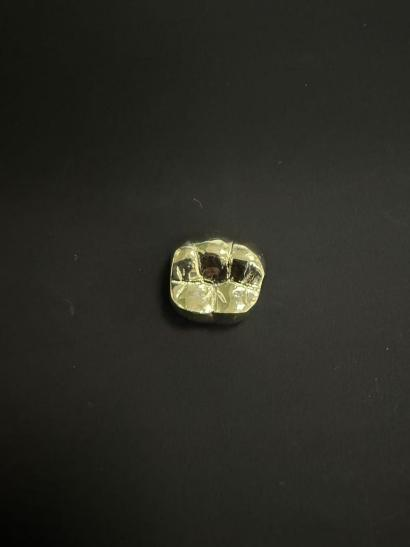 Traditional gold alloy dental restoration