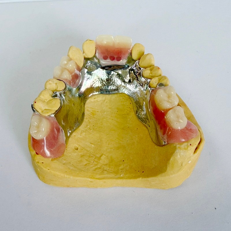 Çıkarılabilir Restorasyon Kısmi Çerçevesi